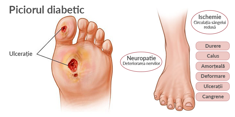 dureri de picioare în diabet